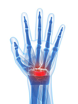 Carpal Tunnel Surgeon Los Angeles